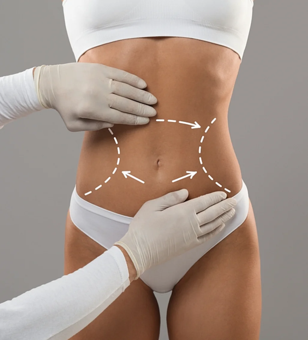 Person's abdomen marked with surgical guidelines.