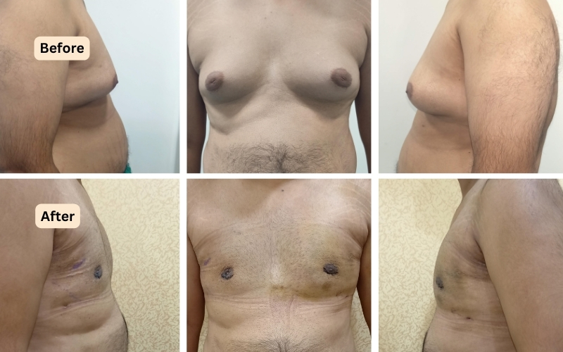 Gynecomastia surgery results.
