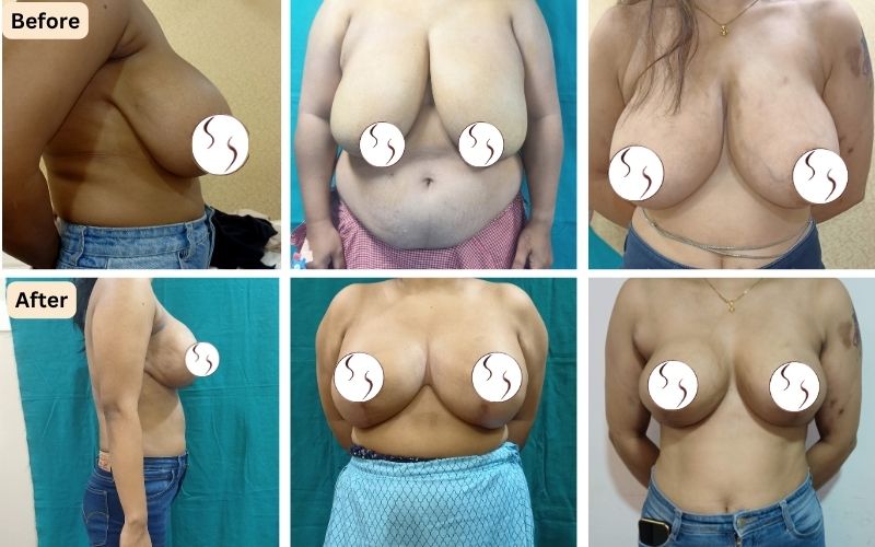 breast-reduction-surgery-before-after-surgery-mumbai-clinic