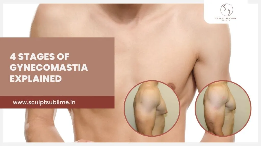 4 stages of gynecomastia explained with before and after chest comparison
