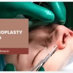 What is Open Rhinoplasty and How Does it Work?