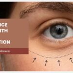 Pre-Operative Guidelines for Under-Eye Bag Surgery: How to Prepare Safely