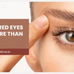 Under-Eye Bags: When Is Blepharoplasty the Right Solution?