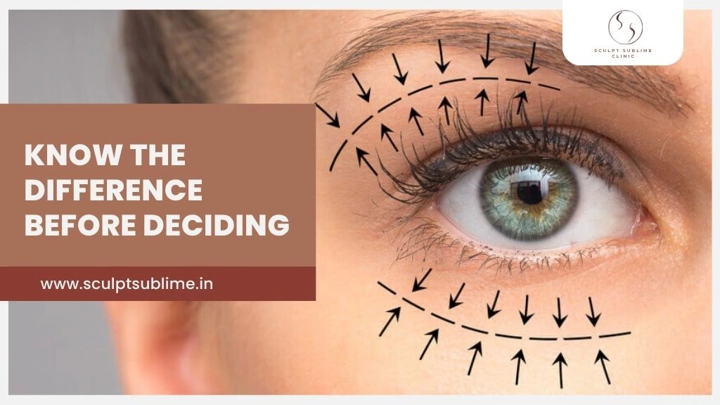 Close-up of eye with markings showing upper and lower blepharoplasty treatment areas.