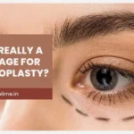 Best Age for Blepharoplasty: Is 40 Too Early or 60 Too Late?