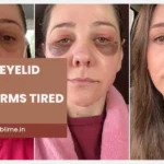 Blepharoplasty Before and After: Real Patient Results