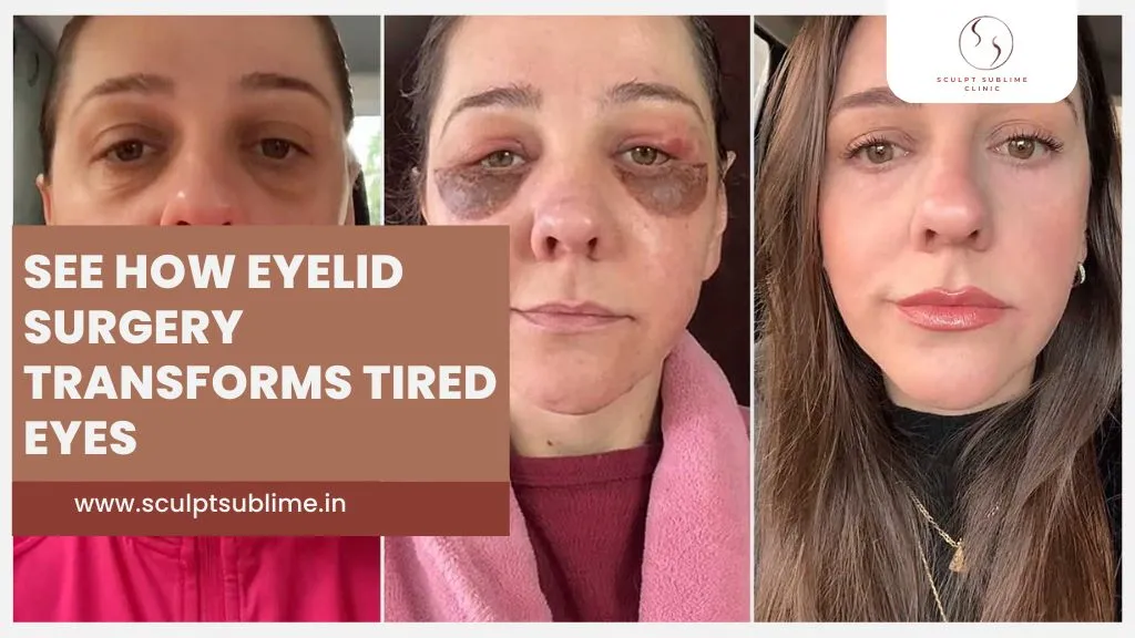 blepharoplasty-before-and-after