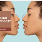 Factors That Affect The Cost Of Rhinoplasty