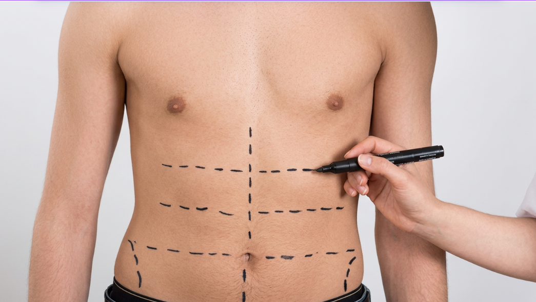 Abdominal Etching Surgery