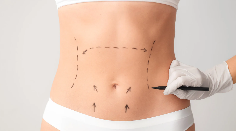 Abdominoplasty (Tummy Tuck)