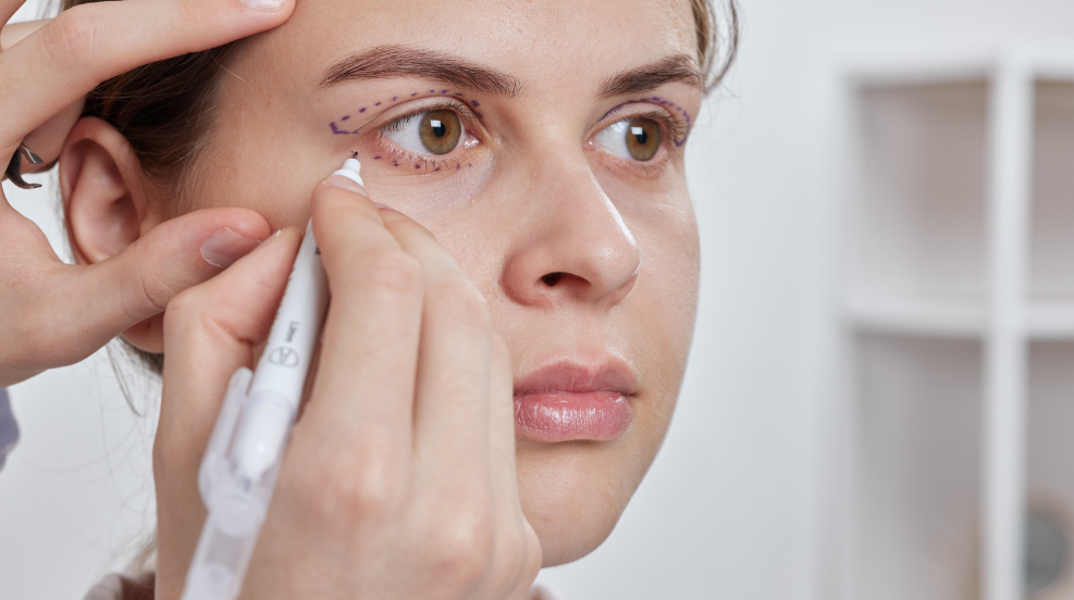 Blepharoplasty Surgery