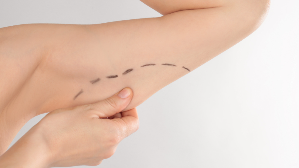 Brachioplasty Surgery