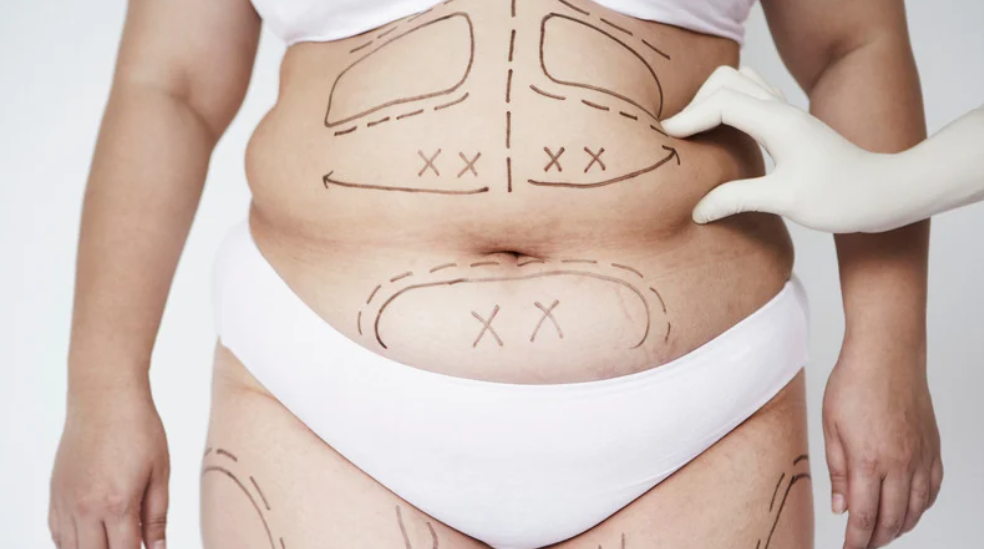 Liposuction Surgery