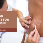 Am I a Good Candidate for Liposuction? BMI & Eligibility Explained