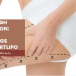 Outer Thigh Liposuction: Reduce Saddlebags with Smartlipo
