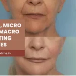 Nano Fat vs Micro Fat vs Macro Fat Grafting: Which One Is Right for You?