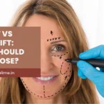 Face Lift vs Thread Lift: Which Should You Choose?