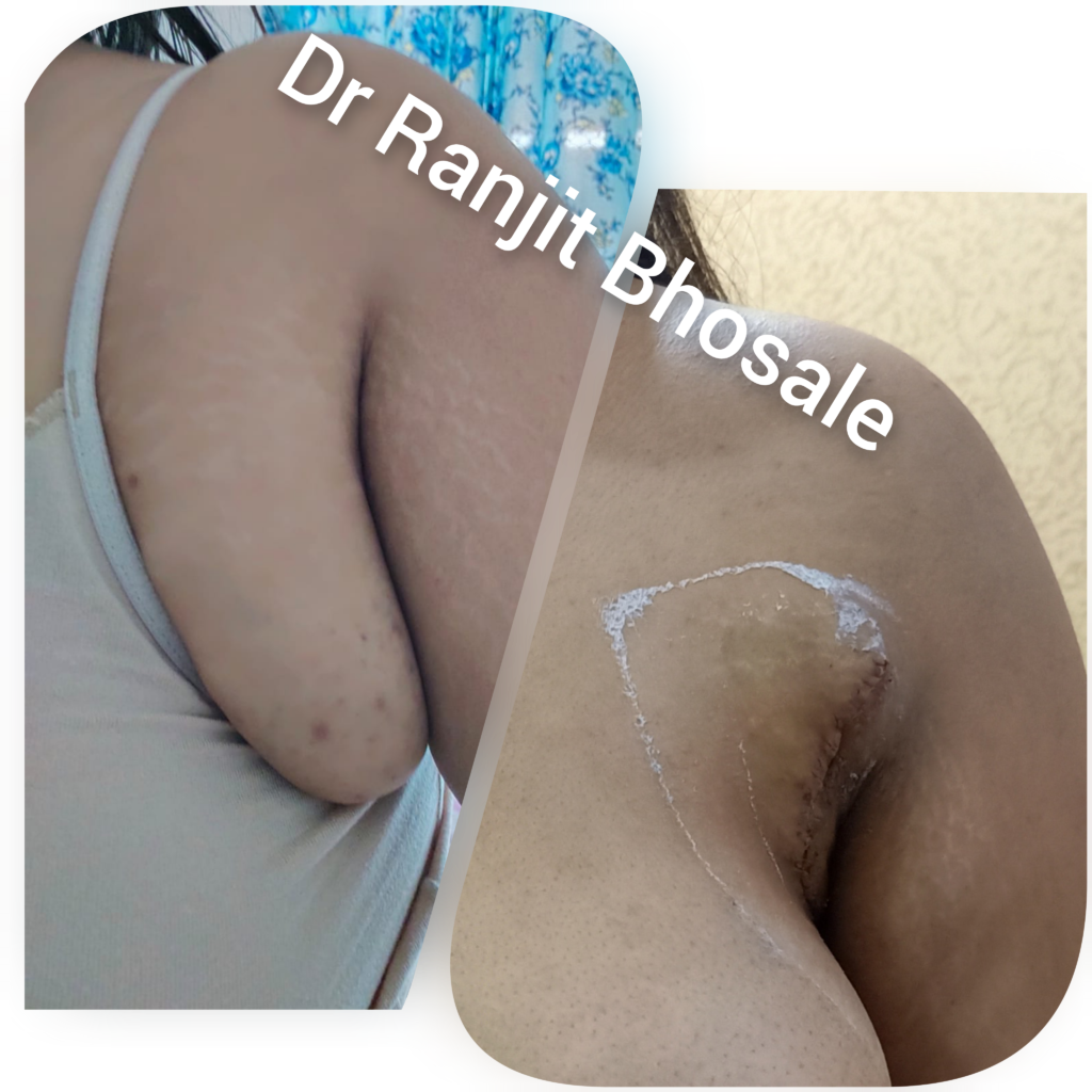 Axillary Breast Surgery Mumbai