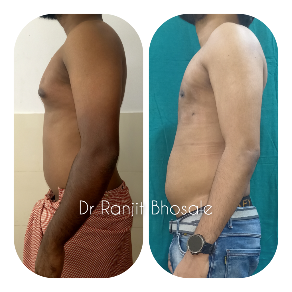 Gynecomastia Surgery Mumbai