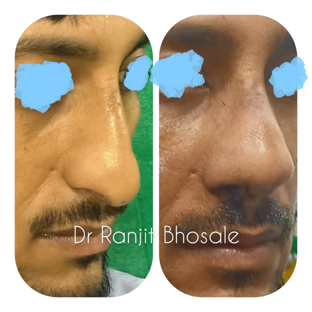 Rhinoplasty Surgery Mumbai