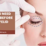 What You Need to Know Before Having Eyelid Surgery