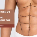 HD Liposuction vs Liposuction: Which Is Right for You?