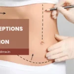 Common Misconceptions About Liposuction